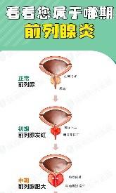 男性前列腺疾病